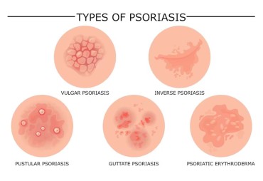 Psoriasis